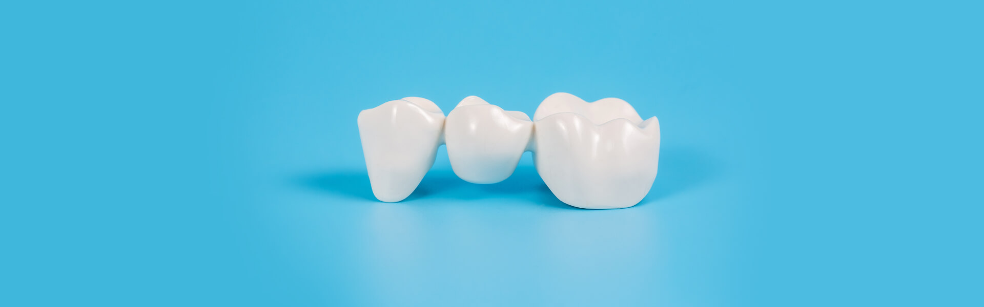 Why Choose Dental Bridges to Replace Missing Teeth?