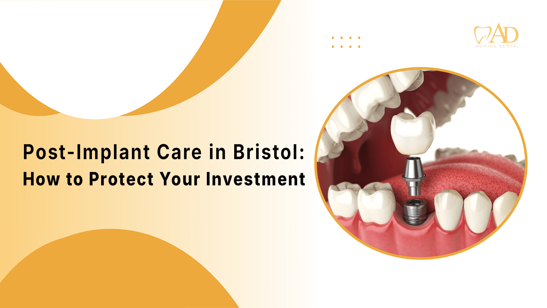 Implant dentistry in Bristol