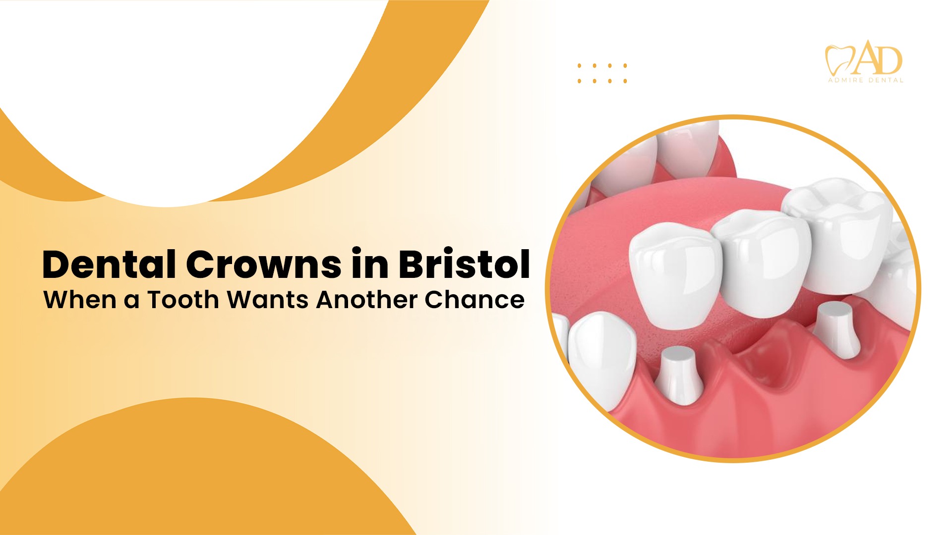 Dental Crowns in Bristol