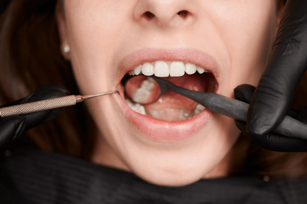 Dental Crowns in Bristol 